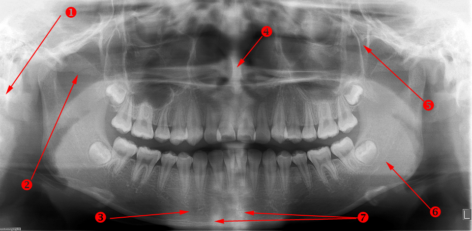 Protocols in Panoramic Radiographic Interpretations